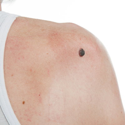 Squamous Cell Carcinoma Squamous Cell Carcinoma